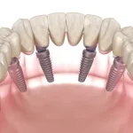 The Social Dynamics of Smiling: How Dental Implants Influence Interpersonal Connections