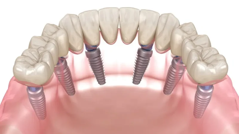 The Social Dynamics of Smiling: How Dental Implants Influence Interpersonal Connections