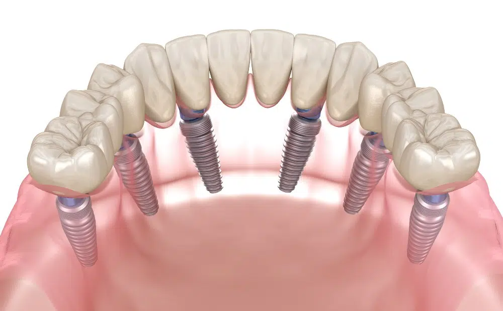 The Social Dynamics of Smiling: How Dental Implants Influence Interpersonal Connections