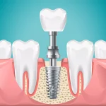 How Dental Implants Respond to Everyday Wear and Maintain Structural Integrity Over Decades