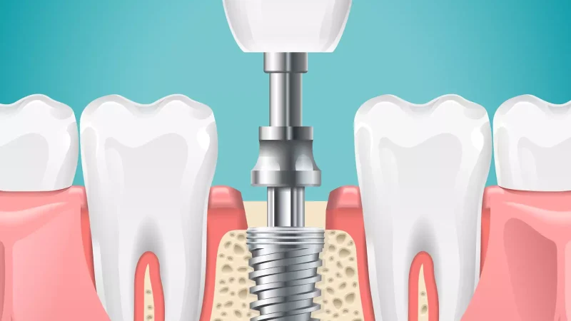 How Dental Implants Respond to Everyday Wear and Maintain Structural Integrity Over Decades