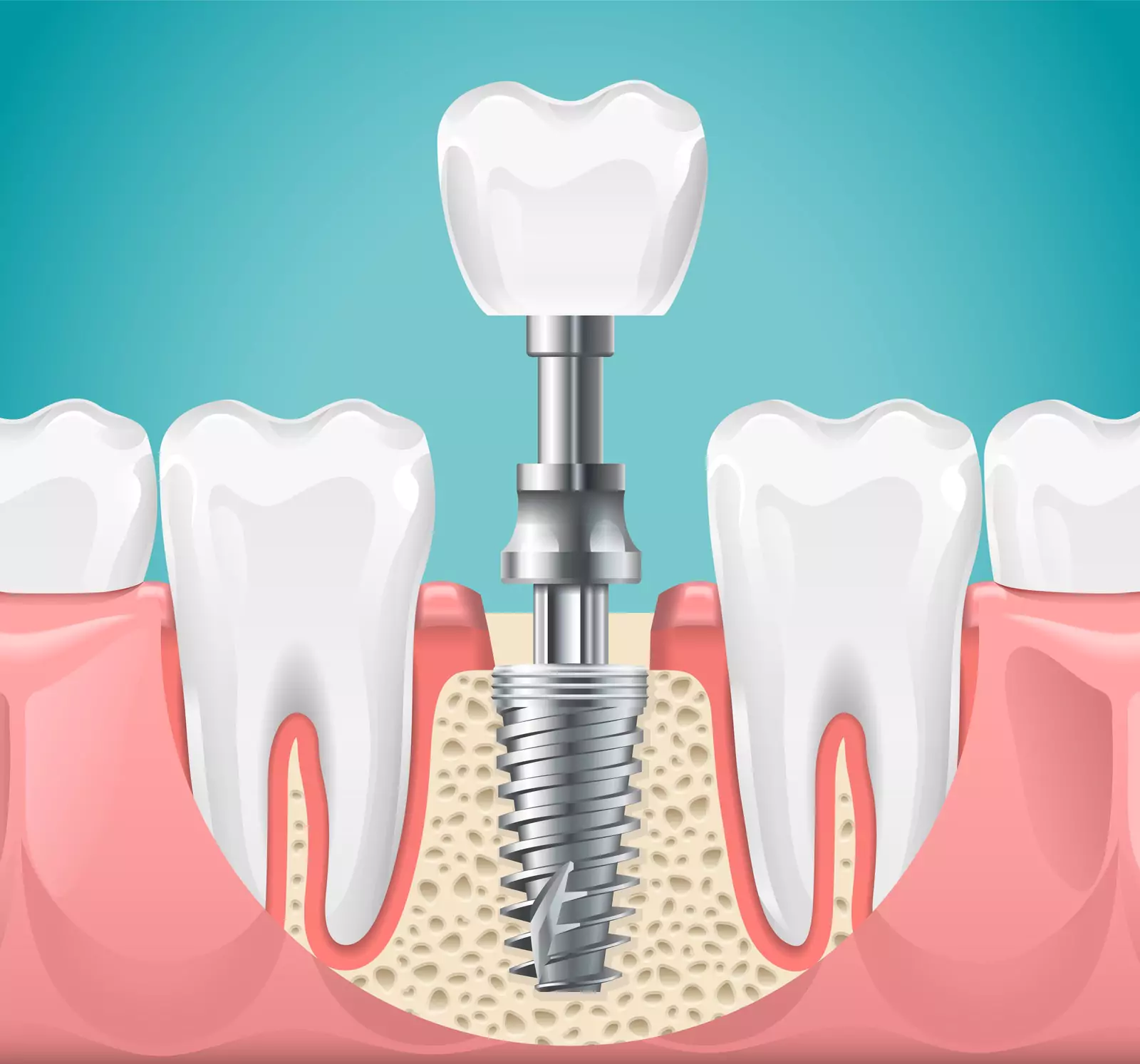 How Dental Implants Respond to Everyday Wear and Maintain Structural Integrity Over Decades